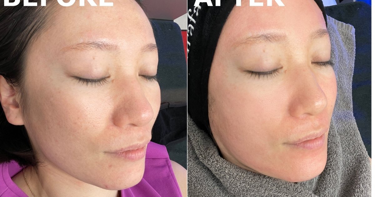 夏の毛穴汚れを洗い流せ！ハイドラフェイシャルで毛穴ツルっピカ