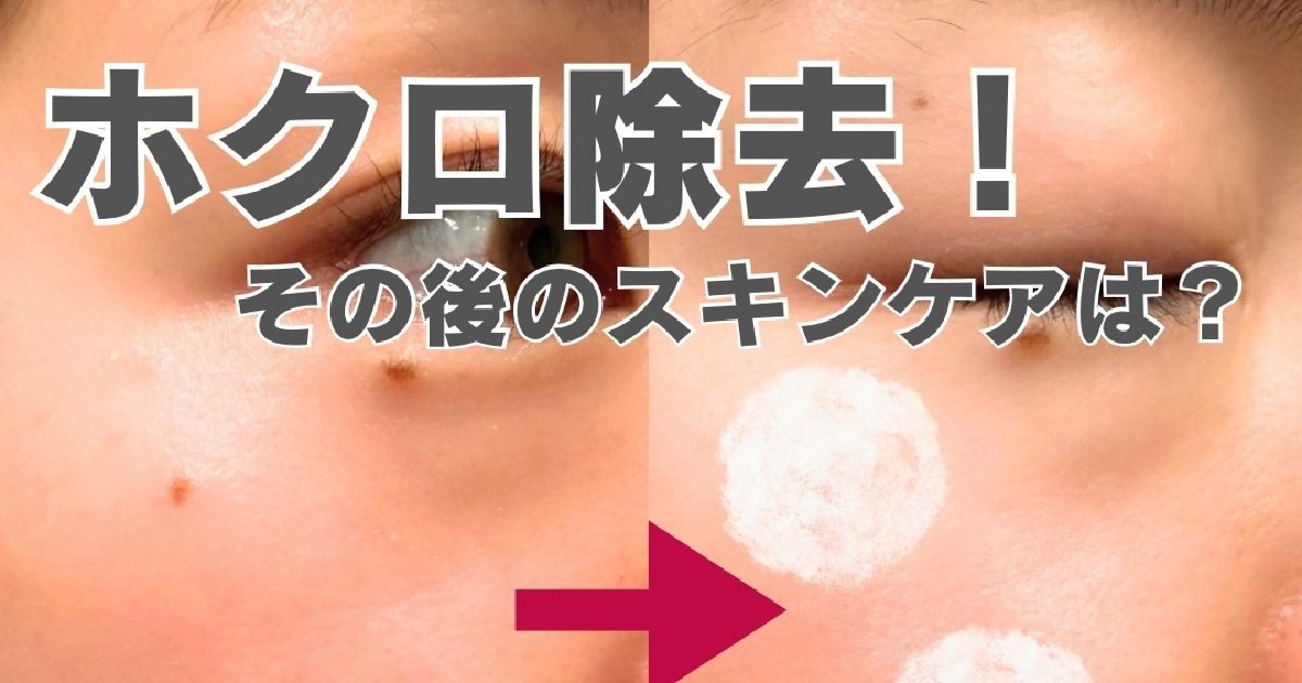 ホクロ2か所除去】その後3か月経過した状態と、スキンケア事情