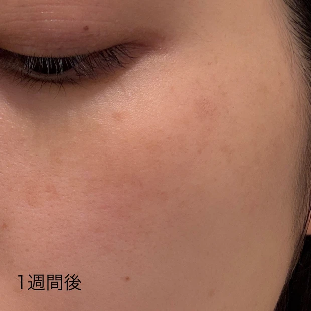 ルビーフラクショナル 1週間後
