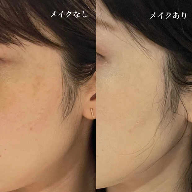 ルビーレーザー　シミ取り