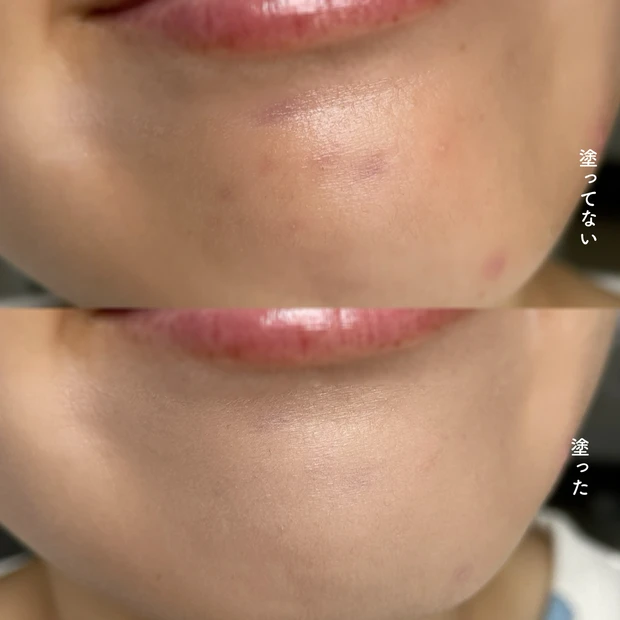 ディオール コンシーラー ニキビ跡に検証