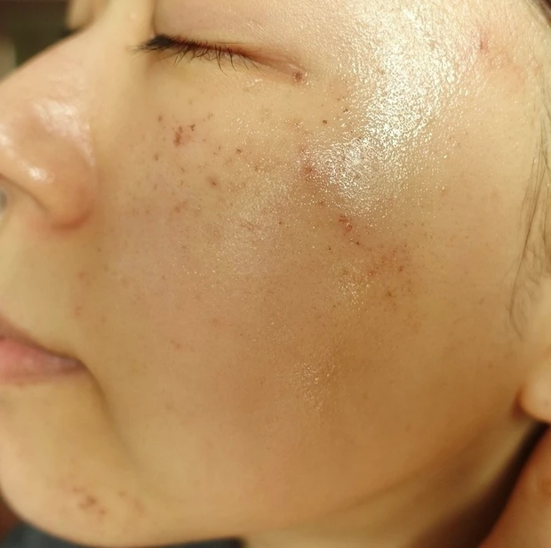 【ご当地美容】上海のヨセミテクリニックでM22(IPL治療)を受けてみた！6回コースでシミそばかすに効果あり！_5_1