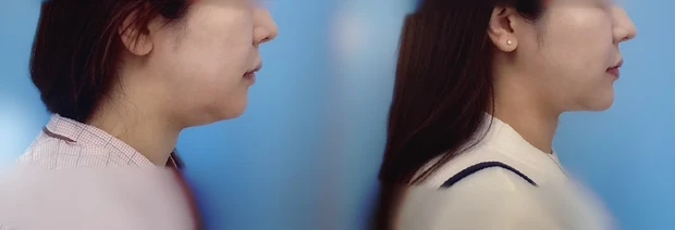 【顎下脂肪吸引受けてきました③】手術から1ヶ月が経ちました〜写真で経過報告〜_2