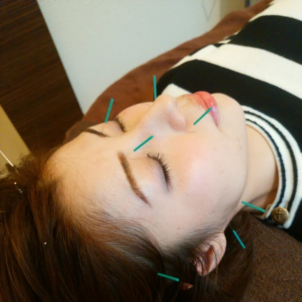 【美容鍼デビューしました】20分お試しコース@美馬メディカルサロン