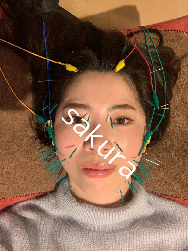 【美容鍼】電気の力で深部にアプローチ!ガチガチ筋肉も緩んですっきり&翌日ツヤ肌続く✨_3