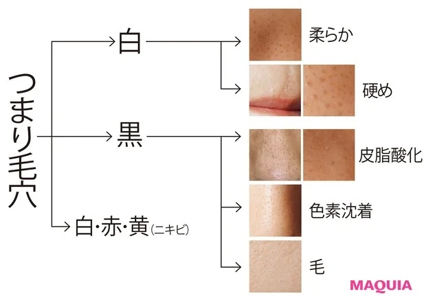 あなたはどのタイプ? つまり毛穴の種類・特徴