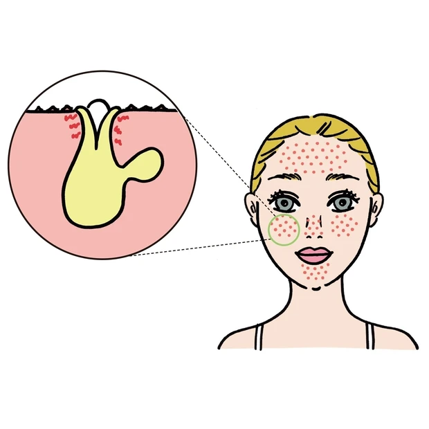 「詰まり毛穴」さんに必要なケア法まとめ。プロが選ぶおすすめコスメも必見！