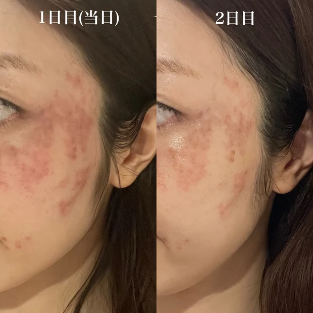 ルビーレーザー　経過　ブログ