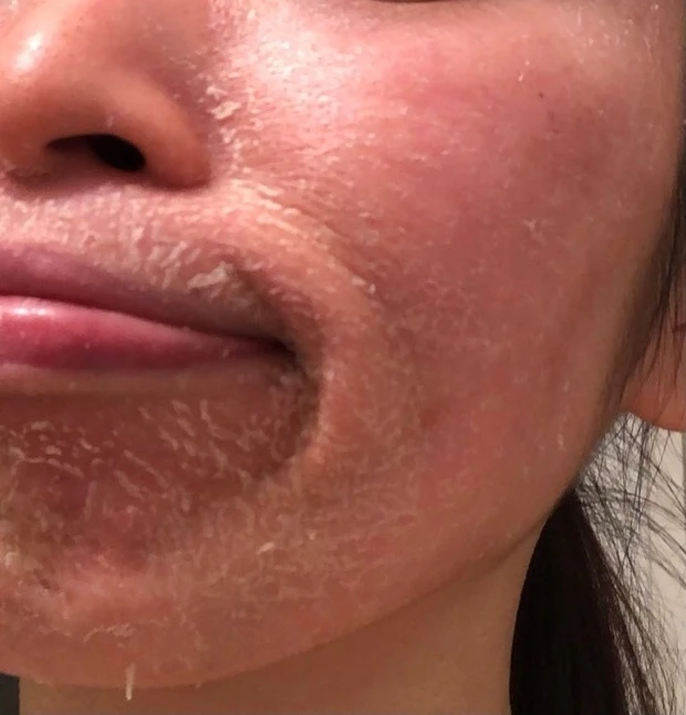 【ゼオスキンヘルス】剥け剥け生活3ヶ月終了しました！~体験報告~_4_3