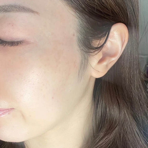 シミ取りレーザー　また出てくる