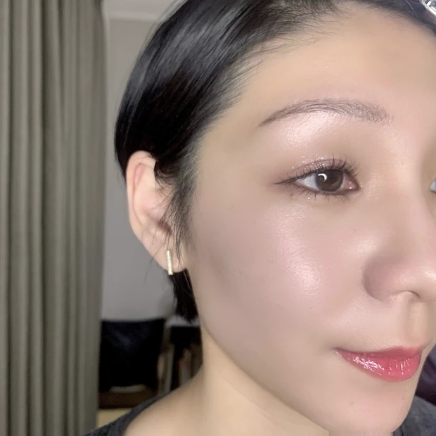 【エリシスセンス体験ブログ】ダウンタイムの経過は?3回施術後の効果を徹底検証!_16