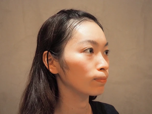 【話題の美容医療レポ】ダーマペンより効果あり？！水光注射を体験_2_1