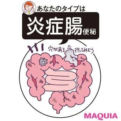 【便秘解消におすすめ】炎症腸便秘タイプさん_小麦が合わない場合は腸の炎症の原因に