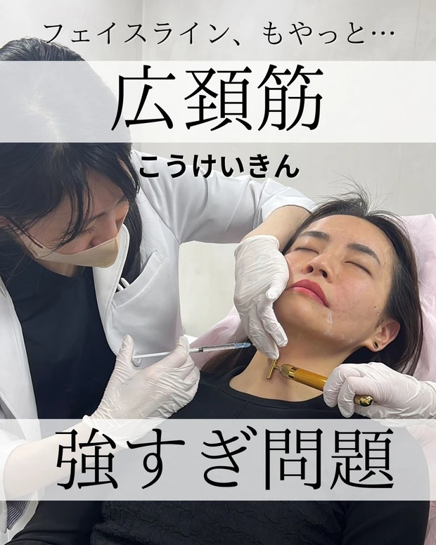 広頚筋ボトックス_リフトアップボトックス