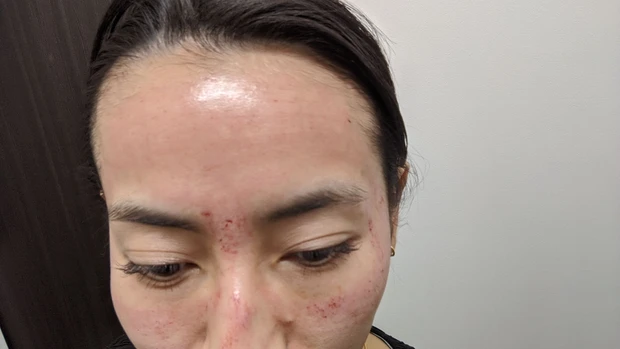 ダーマペン４施術直後（額）