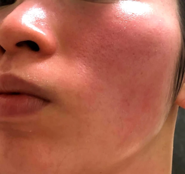 【ゼオスキンヘルス】剥け剥け生活3ヶ月終了しました！~体験報告~_5_3