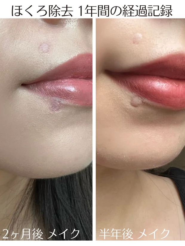 ほくろ除去 経過レポート ビフォーアフター 美容医療 体験談