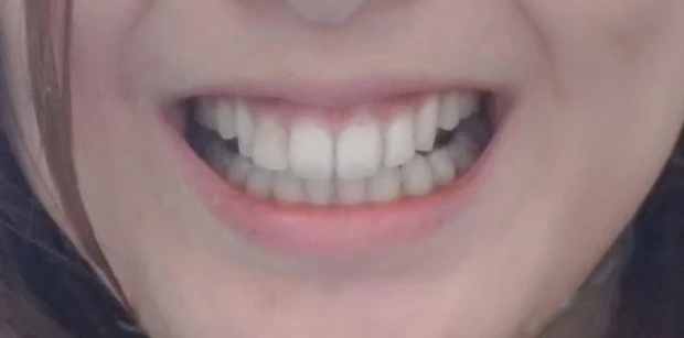 過蓋咬合