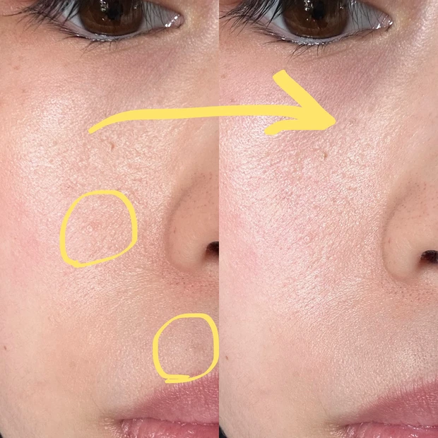 2023年、私がやってよかった美容話【炭酸ガスレーザーによるほくろ除去～経過、傷跡カバーアイテムについて】_4