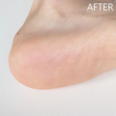 「フットケアキット2」使用後(右足)