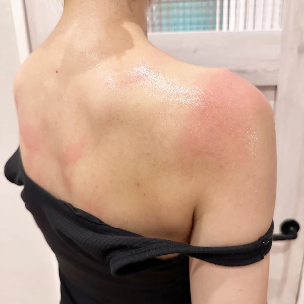 うっかり日焼け