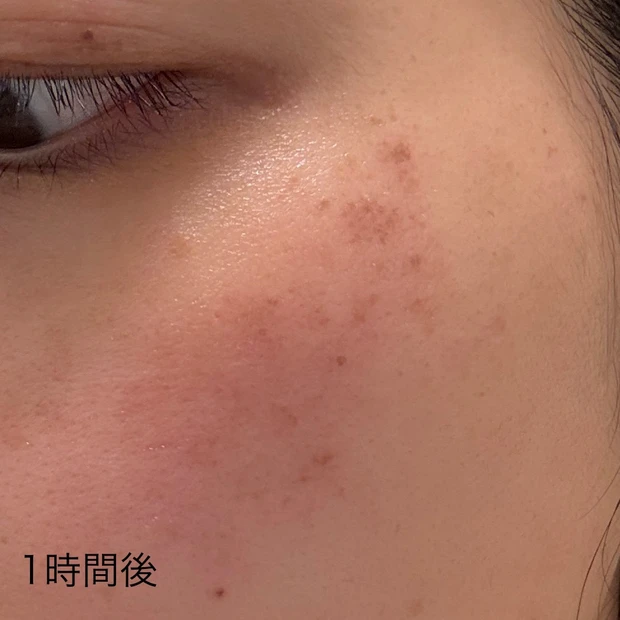 ルビーフラクショナル 施術1時間後
