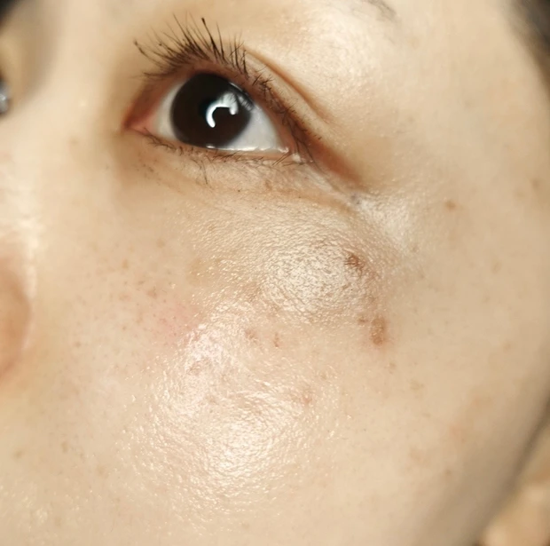 【ご当地美容】上海のヨセミテクリニックでM22(IPL治療)を受けてみた！6回コースでシミそばかすに効果あり！_4_1