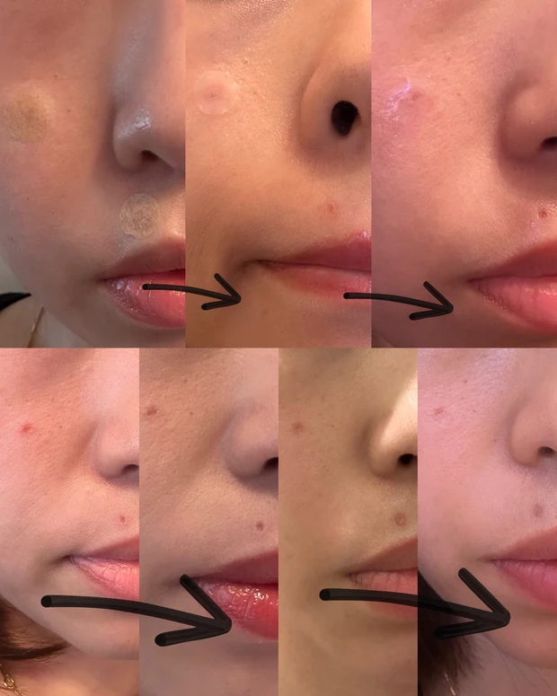 2023年、私がやってよかった美容話【炭酸ガスレーザーによるほくろ除去～経過、傷跡カバーアイテムについて】_2