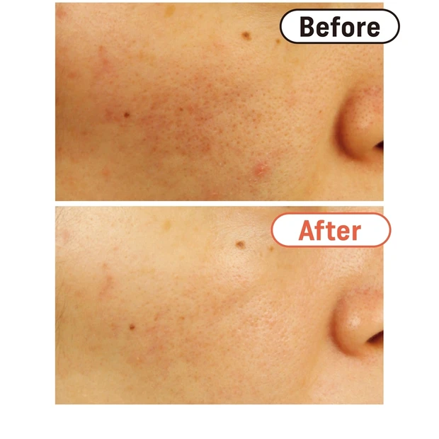 「ニキビ」「毛穴」を美容医療で治療するなら？ 世代別の王道＆おすすめの施…