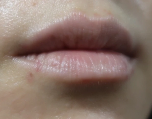 美容皮膚科施術「ピコスポット」_4_2