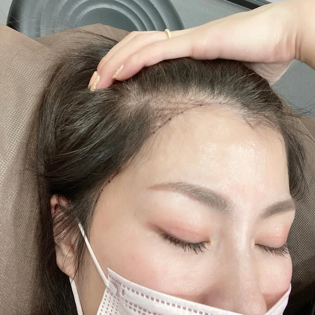 施術動画あり!ヘアラインアートメイクって知ってる?生え際のアートメイクとっても気に入ったのでレビューします!
_3_2