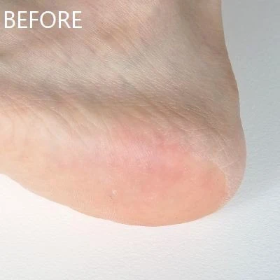 「フットケアキット2」使用前(左足)