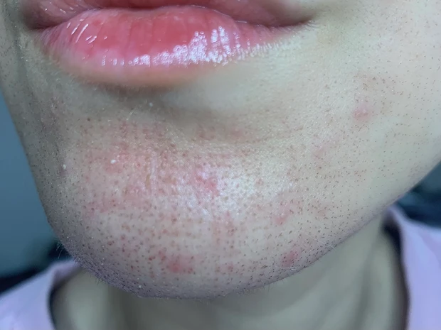 エリシスセンス ダウンタイム 3日目 経過 ニキビ悪化