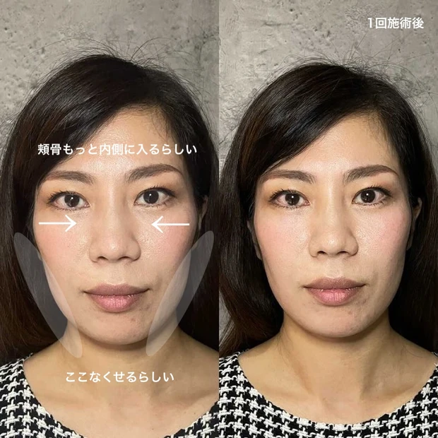 小顔矯正 美容鍼 鍼 骨格メンテナンス 骨格矯正