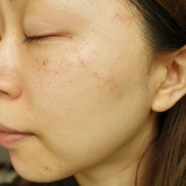 【ご当地美容】上海のヨセミテクリニックでM22(IPL治療)を受けてみた！6回コースでシミそばかすに効果あり！_7_1