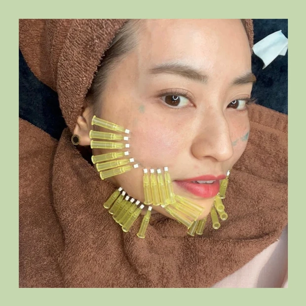 【美容医療】肌の内部、真皮に効果がある治療を美容クリニックカウンセラーが解説します！_3