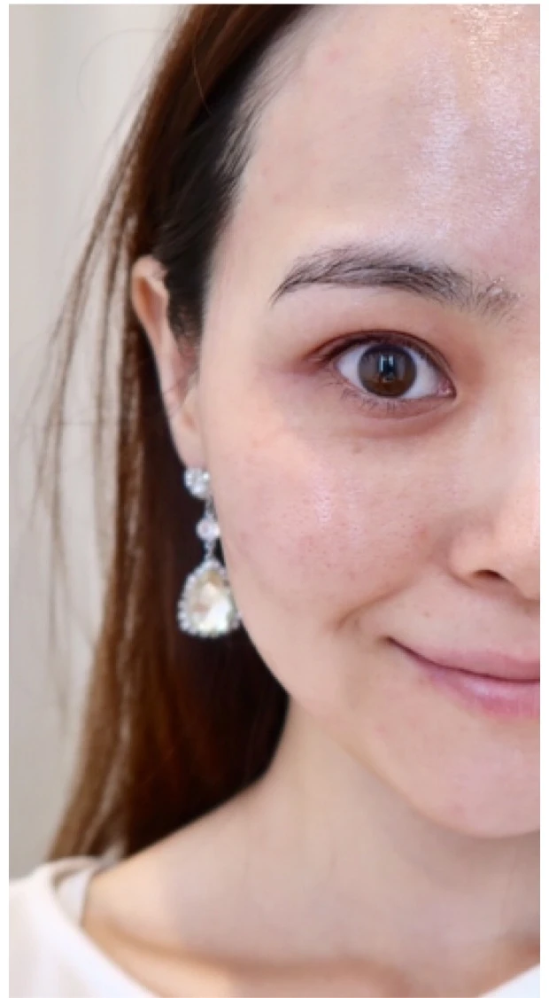 【美容皮膚科】ピコトーニング_1_1