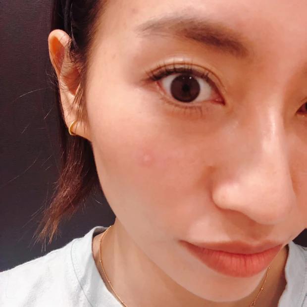 ベビーコラーゲン注入直後