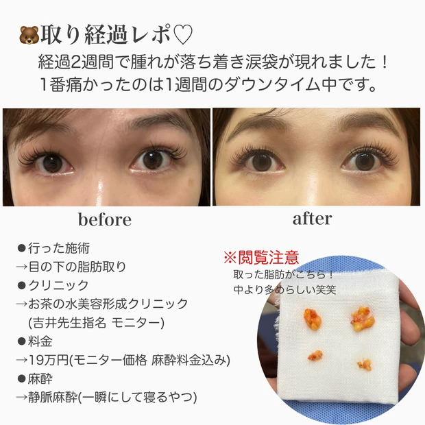 【美容医療】本当は内緒にしたいクマ取りレポート！ダウンタイムから完成まで全部お見せします！_3