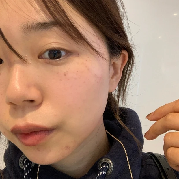 【ご当地美容】上海のヨセミテクリニックでM22(IPL治療)を受けてみた！6回コースでシミそばかすに効果あり！_6_2