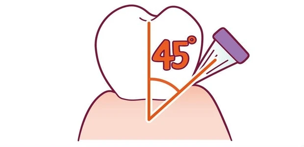 45度でのもじもじ磨きが効果的