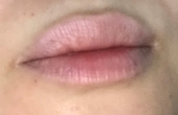 美容皮膚科施術「ピコスポット」_6_2