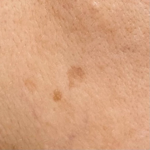 スポットシミケアを２種比較。できちゃったシミにも効くの？答えはYES!!_4_2