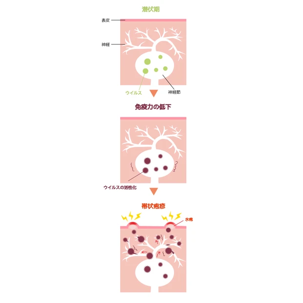 帯状疱疹 原因 治療法 予防接種 ワクチン