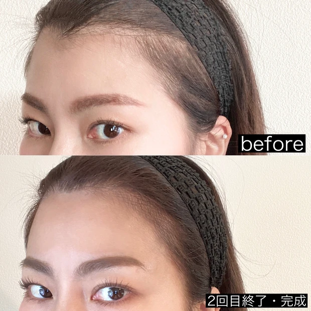 施術動画あり!ヘアラインアートメイクって知ってる?生え際のアートメイクとっても気に入ったのでレビューします!
_7