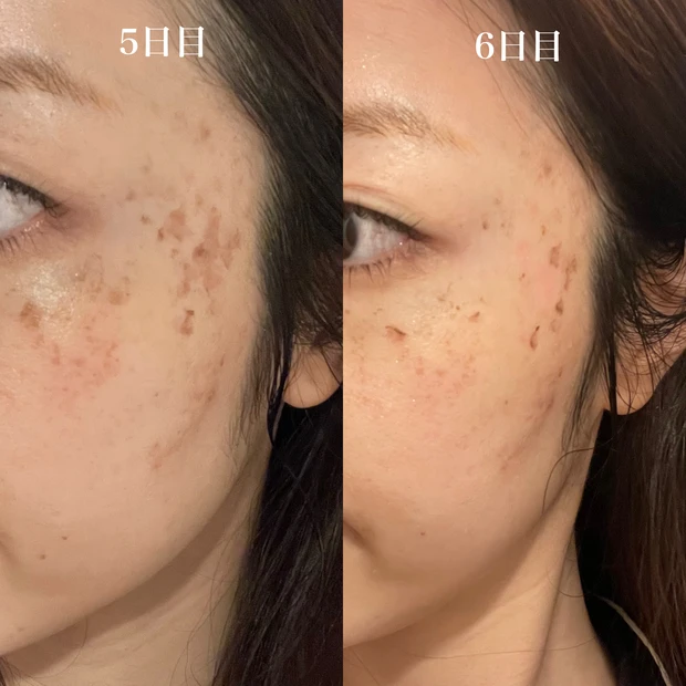 シミ取りレーザー　DT