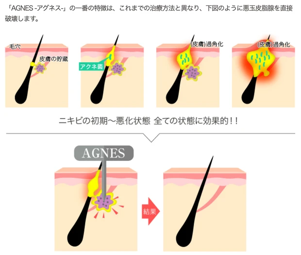 治らない　皮膚科　治し方　原因　アグネス　大人ニキビ　繰り返す大人ニキビ　フェイスラインのニキビ　ニキビ　しつこいニキビ　ニキビ辛い　ニキビのストレス