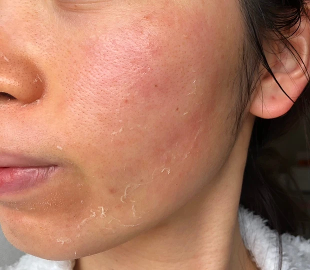 【ゼオスキンヘルス】剥け剥け生活3ヶ月終了しました！~体験報告~_4_1