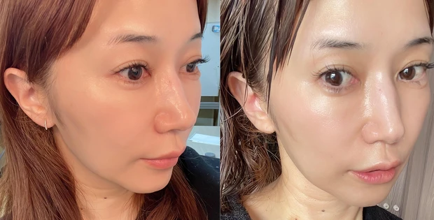 美容課金 小顔矯正