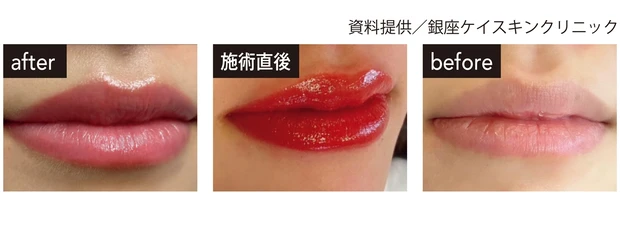 色・輪郭悩みにはアートメイク